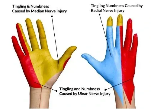 nerve distribution causing hand numbness