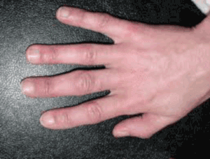 arthritis in finger joint