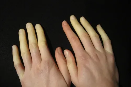 hands with Raynaud's disease