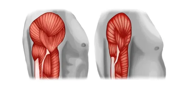 Illustration of arm muscle degeneration with sarcopenia.