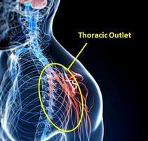Self Tests Thoracic Outlet Syndrome for Carpal Tunnel