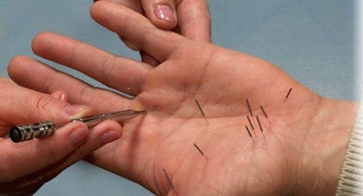 Doctor appllies acupuncture for treating carpal tunnel syndrome.