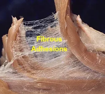 Fibrous adhesions produce carpal tunnel syndrome