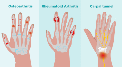 Carpal tunnel vs arthritis