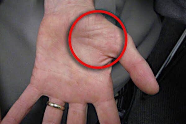 Photo of where thenar atrophy occurs in end stage carpal tunnel syndrome.