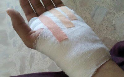 A bandaged hand after carpal tunnel surgery.