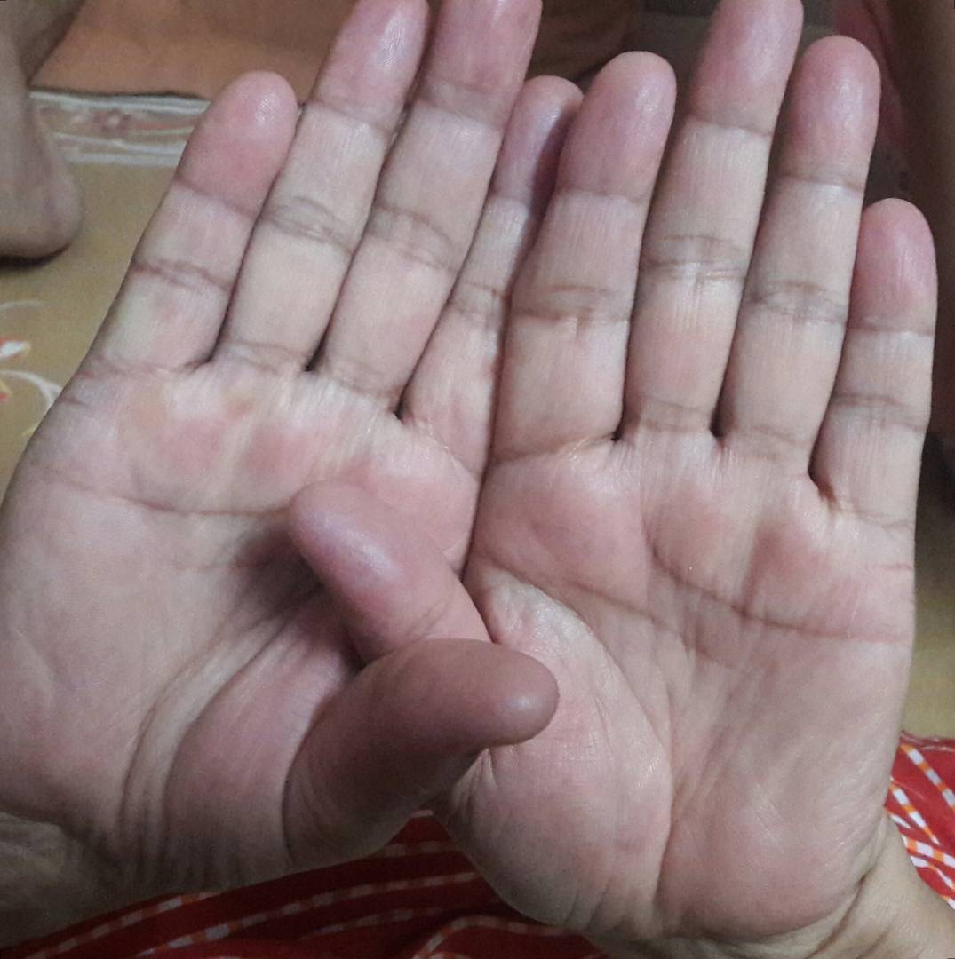 Two hands held together depict bilateral carpal tunnel syndrome.