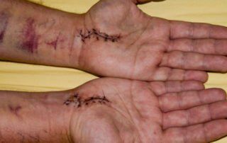 Wrist scars following bilateral carpal tunnel syndrome surgery.
