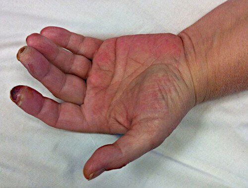 Burned fingers in a patient with loss of feeling due to carpal tunnel syndrome.