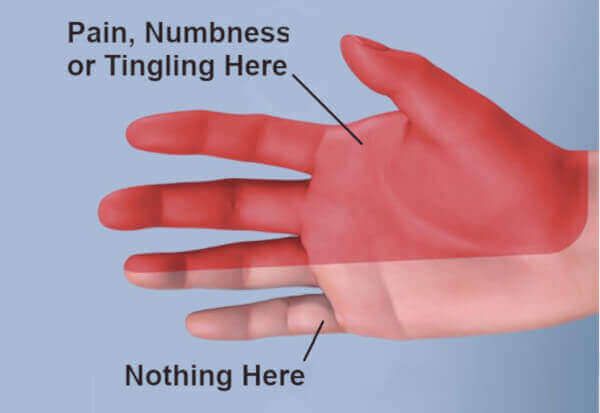 Diagram of where carpal tunnel symptoms occur.