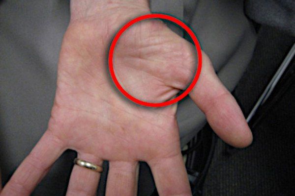 Location of thenar atrophy with end stage carpal tunnel.