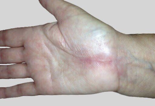 A carpal tunnel surgery scar after 1 year.