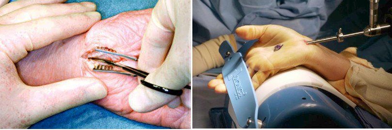 Two basic types of carpal tunnel surgery: open and endoscopic.