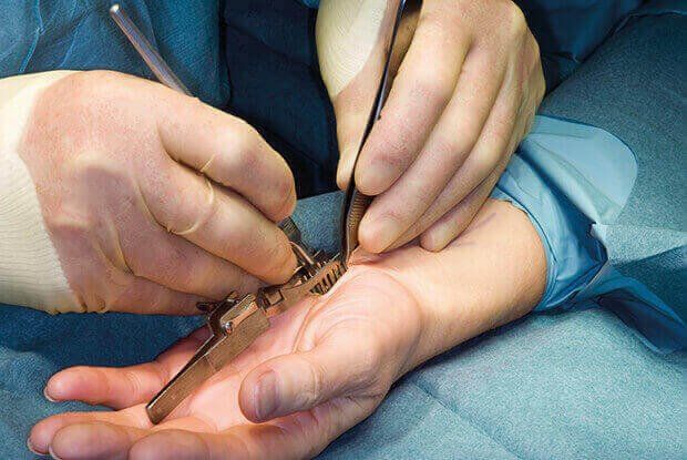A doctor performs open carpal tunnel release surgery.