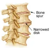 diagram of cervical spondylosis