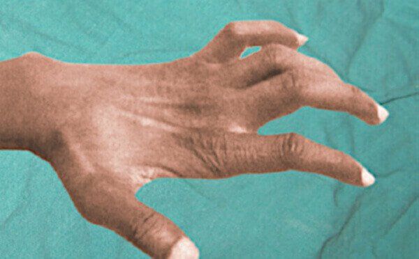 Claw hand in a patient with advanced severe carpal tunnel syndrome.
