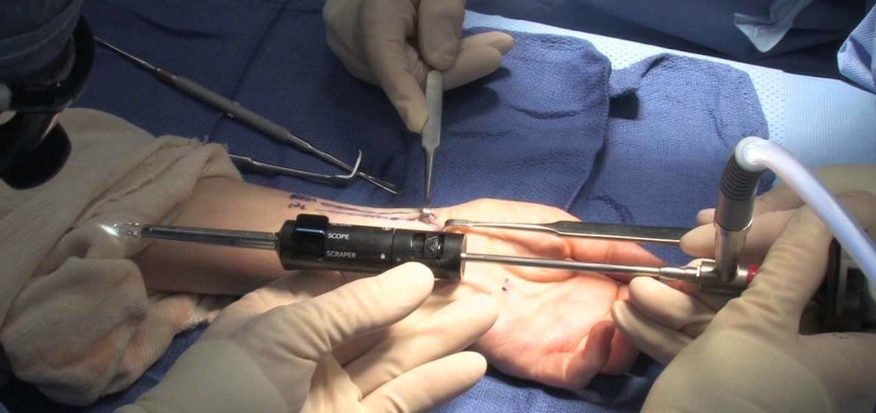 endoscopic carpal tunnel release