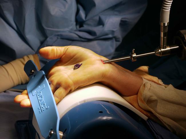 Doctor performs endoscopic carpal tunnel release surgery.