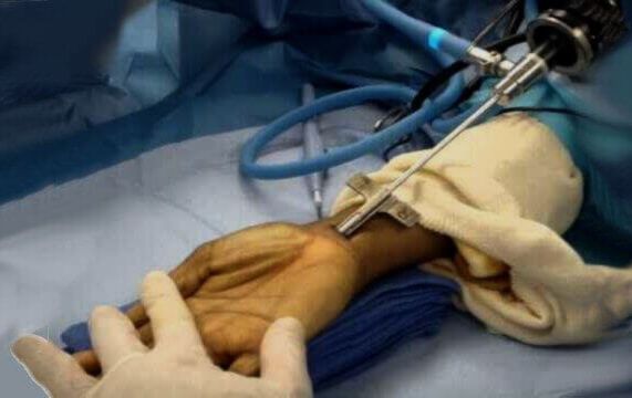 endoscopic carpal tunnel surgery