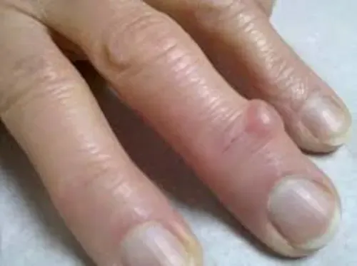 a finger cyst