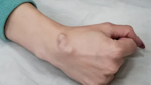 ganglion cysts on the wrist