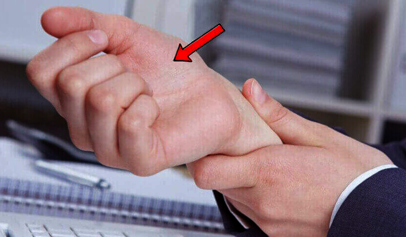 thenar muscle in carpal tunnel syndrome