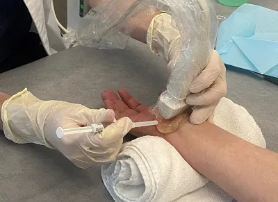 hydrodissection for carpal tunnel