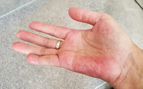 lupus rash in a hand