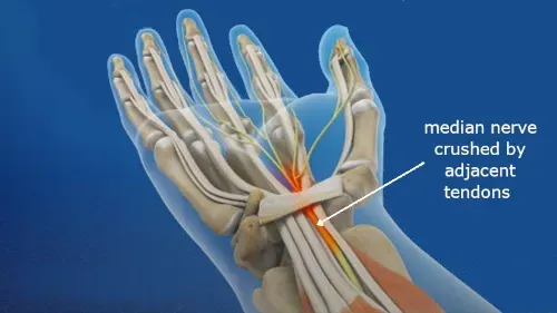 median nerve and tendon inside the wrist