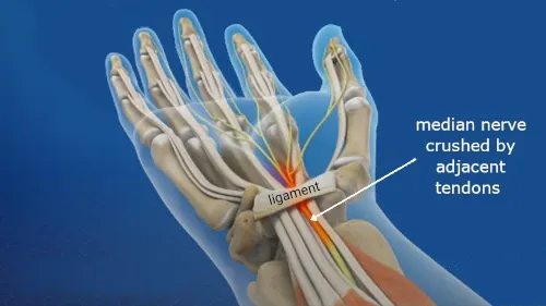median nerve in the carpal tunnel