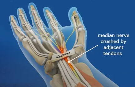 the wrist's carpal tunnel and median nerve