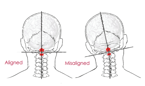 cervical spine misalignment