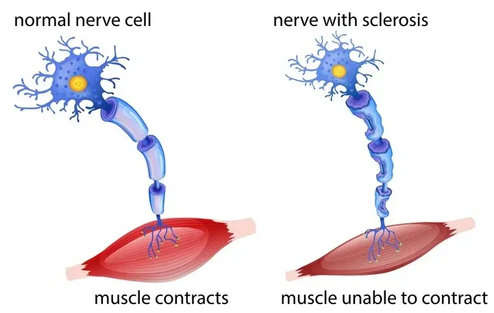 Illustrative anatomy of multiple sclerosis.