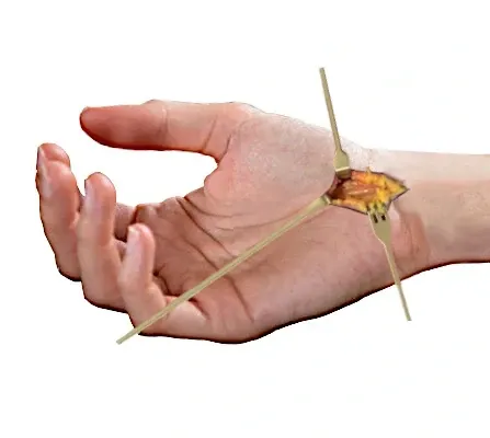 open carpal tunnel release surgery