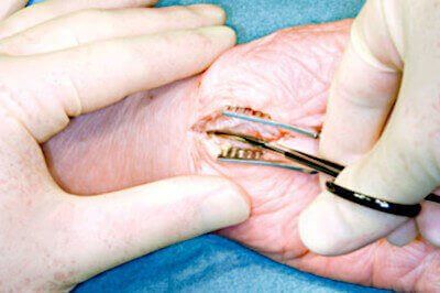 Doctor performs open carpal tunnel release surgery.