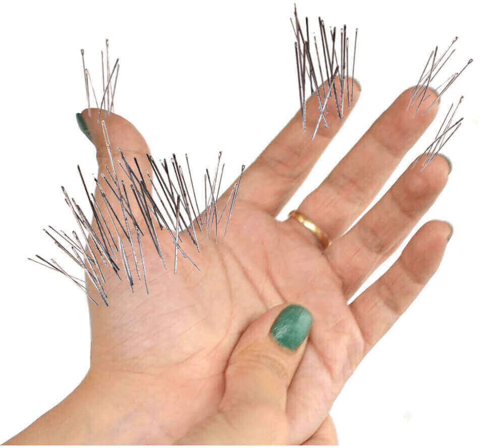Illustration of where pins & needles occurs with carpal tunnel syndrome.