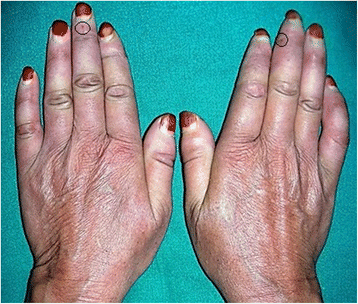 Erythromelalgia and scleroderma in a woman's hands.