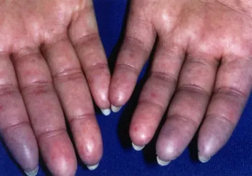 scleroderma in the hands