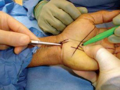 endoscopic carpal tunnel release surgery