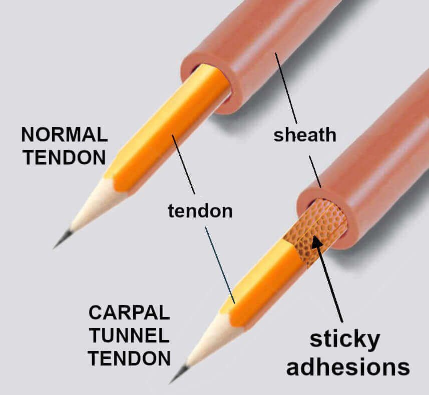 illustration of sticky tendons