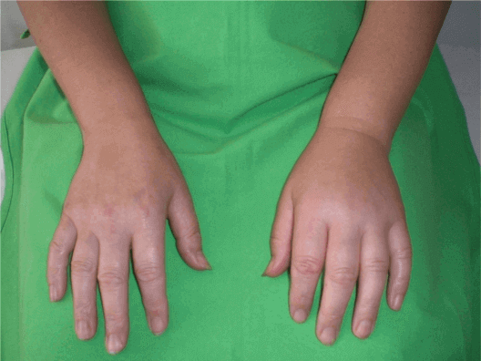 swollen fingers and hand