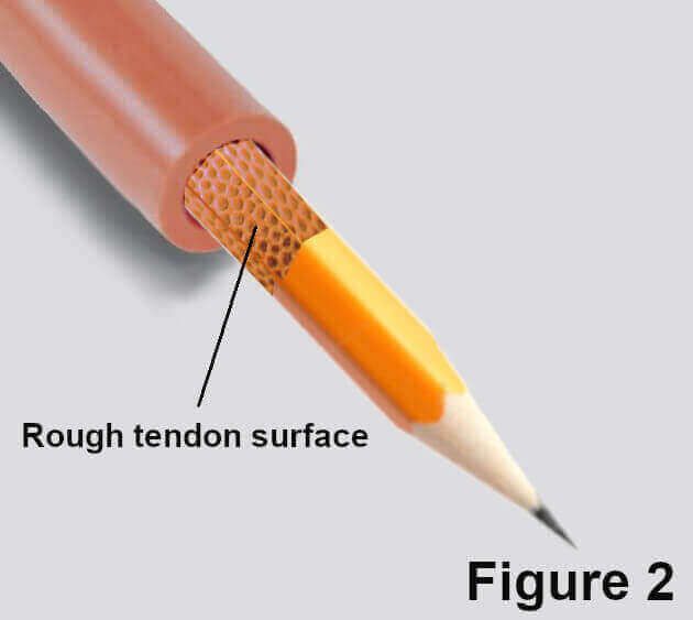 tendon adhesions illustration