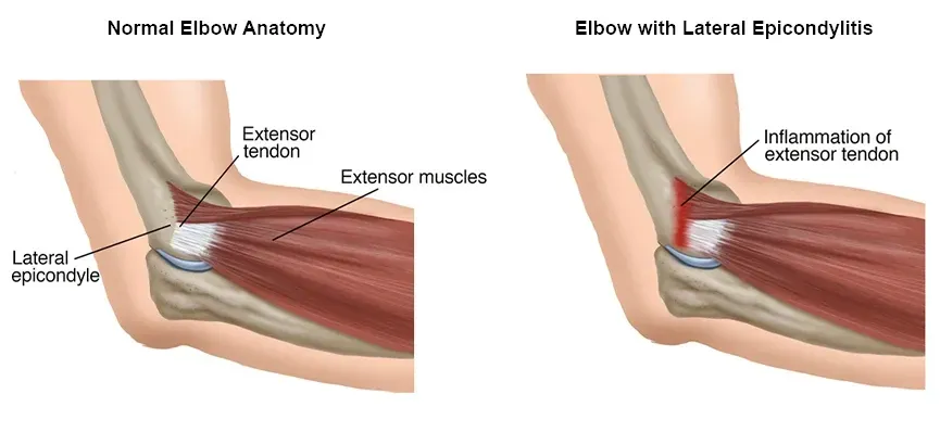 Illustration of the location of lateral epicondylitis.