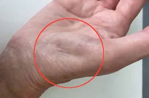 thenar muscle atrophy