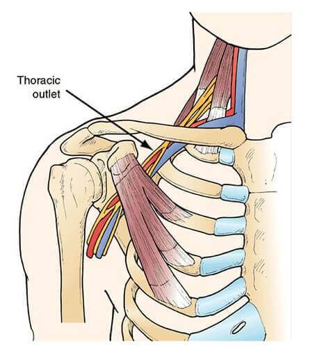 Diagram of the thoracic outlet which causes thoracic outlet syndrome.