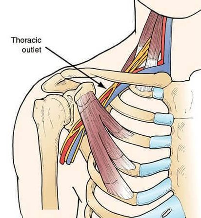 Diagram of the thoracic outlet which causes thoracic outlet syndrome.