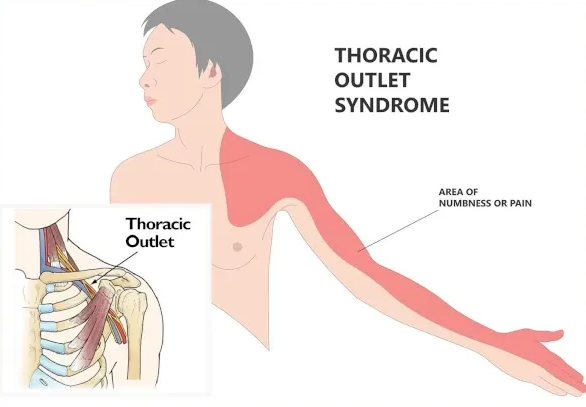 Illustration of Thoracic Outlet Syndrome