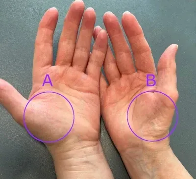 thumb muscle atrophy