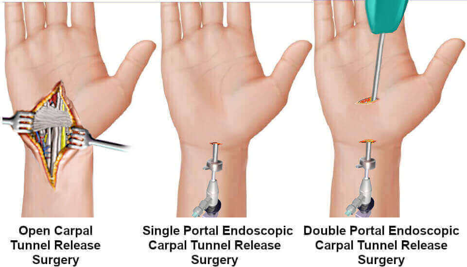 Illustration showing the 3 main types of carpal tunnel surgery.