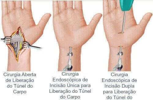 Como É Feita A Cirurgia Do Túnel Do Carpo